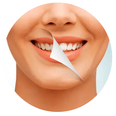 Discoloured Teeth