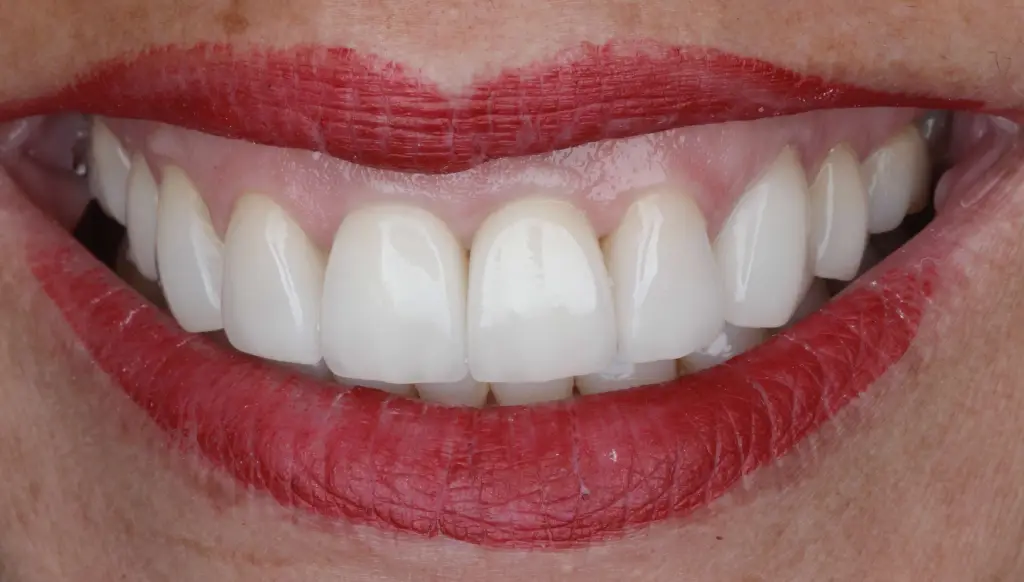 Implant Dental Treatment after