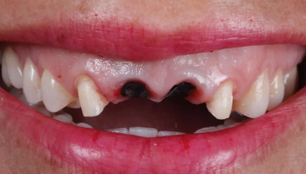 Implant Dental Treatment before