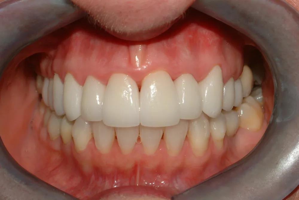 AFTER photo for case 29