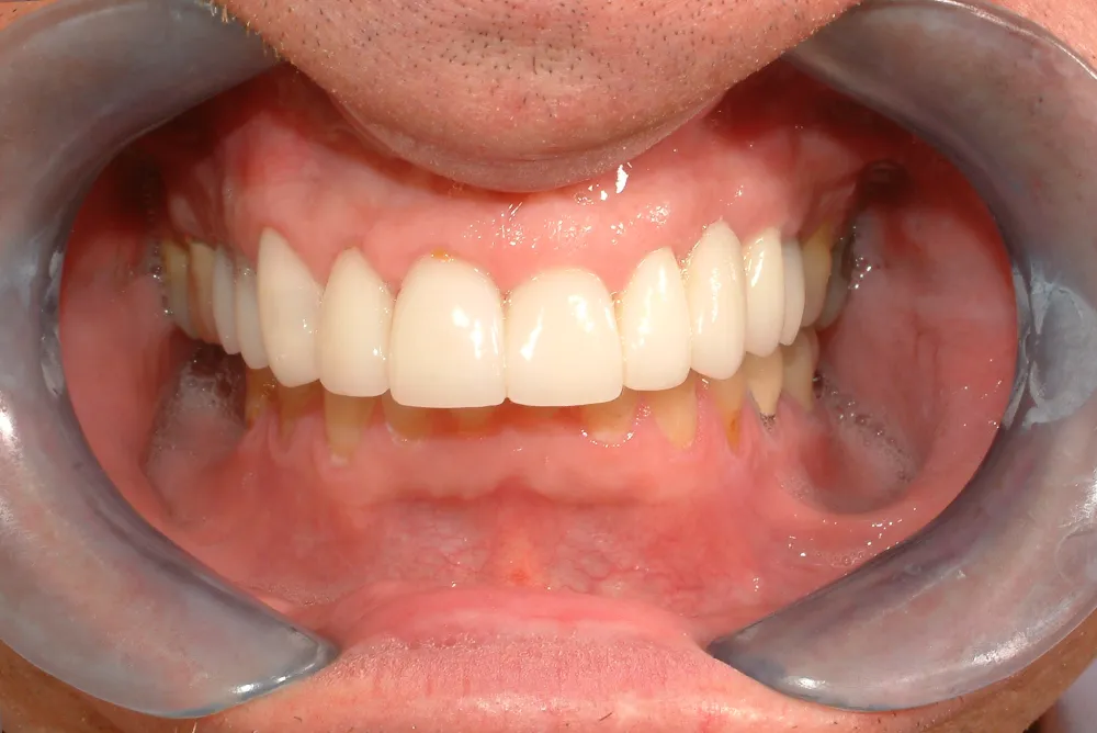 Case 87_ CLTG – After