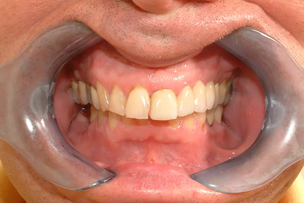 Case 87_ CLTG – Before