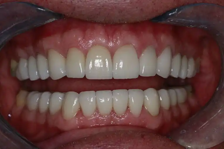 Cosmetic Dental Procedure After Case