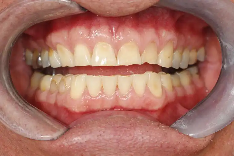 Cosmetic Dental Procedure Before Case