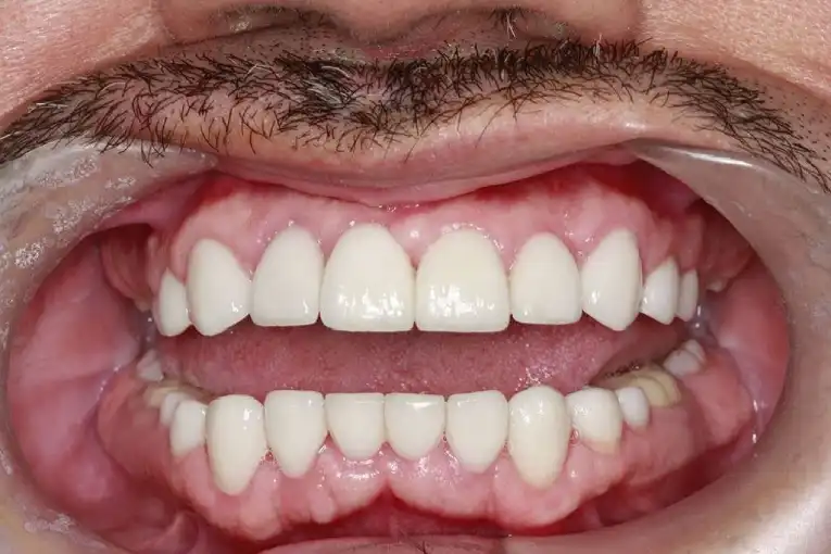 Cosmetic Dentistry After Treatment