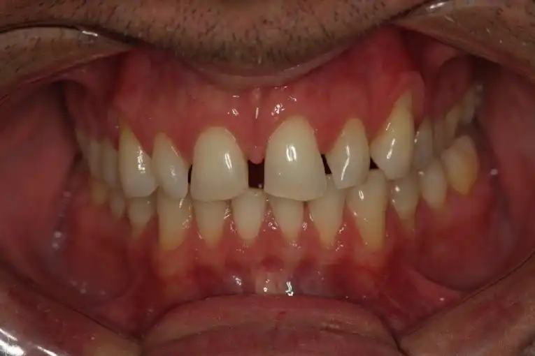 Cosmetic Dentistry Before Case
