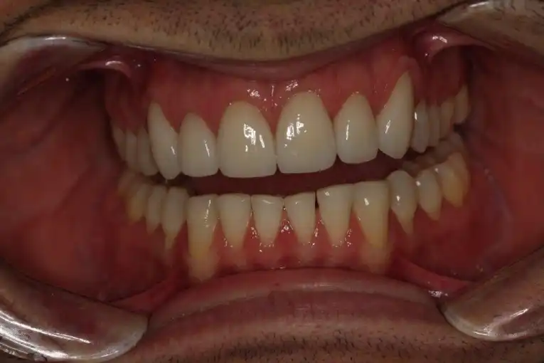 Cosmetic Dentistry Before and After Case