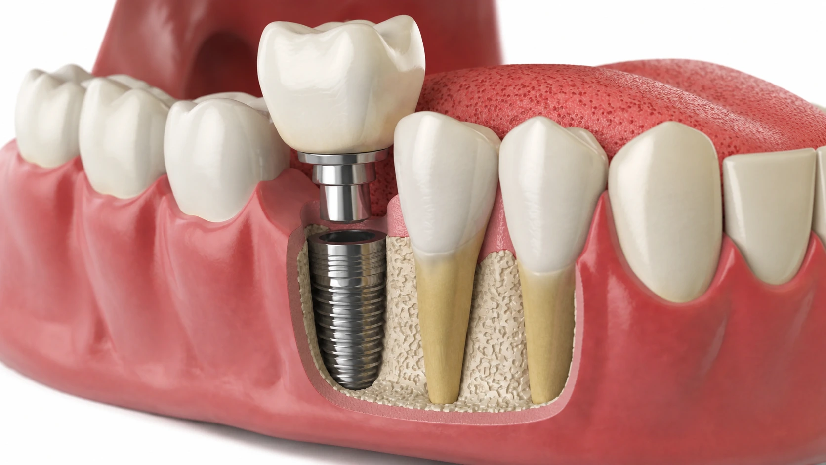 dental implant toronto